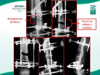 Fios K na diáfise e metáfise Alongamento do fêmur 