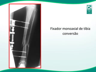 Fixador monoaxial de tíbia conversão 