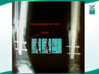 Deformidade em varo Poller 