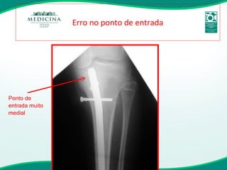 Erro no ponto de entrada Ponto de entrada muito medial 
