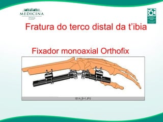 Fixador monoaxial Orthofix Fratura do terco distal da t’ibia 
