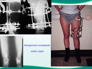 Alongamento completado Joelho rígido 
