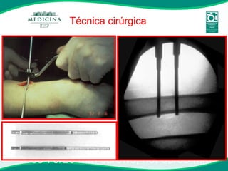 Use 70/20 mm screws, not 85/35 mm Técnica cirúrgica 