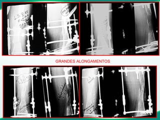 GRANDES ALONGAMENTOS 