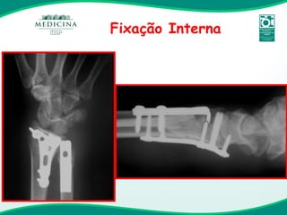Fixação Interna 