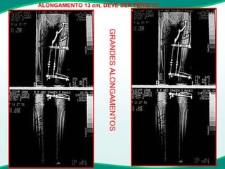 ALONGAMENTO 13 cm, DEVE SER FEITO ?? GRANDES ALONGAMENTOS 