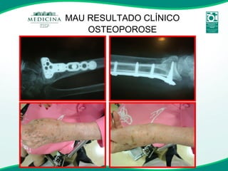 MAU RESULTADO CLÍNICO OSTEOPOROSE 