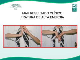 MAU RESULTADO CLÍNICO FRATURA DE ALTA ENERGIA 