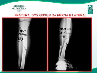 FRATURA  DOS OSSOS DA PERNA BILATERAL 