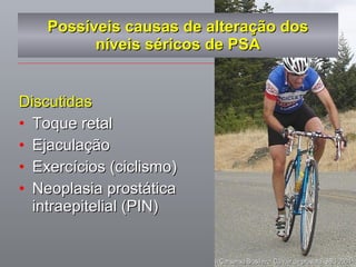 Possíveis causas de alteração dos níveis séricos de PSA Discutidas Toque retal Ejaculação Exercícios (ciclismo) Neoplasia prostática intraepitelial (PIN)  II Consenso Brasileiro: Câncer de próstata. SBU 2004  