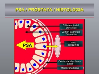PSA / PRÓSTATA / HISTOLOGIA PSA Célula epitelial  prostática Lúmen Glândula  Prostática Vaso sangüíneo Célula da Membrana basal Membrana basal 