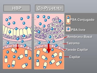Capilar Parede Capilar Estroma Membrana Basal  PSA livre PSA Conjugado HBP Ca-Próstata 