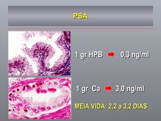 PSA 1 gr HPB   0,3 ng/ml 1 gr  Ca   3,0 ng/ml MEIA VIDA: 2,2 a 3,2 DIAS 