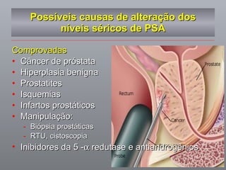 Possíveis causas de alteração dos níveis séricos de PSA Comprovadas Câncer de próstata Hiperplasia benigna Prostatites Isquemias Infartos prostáticos Manipulação: Biópsia prostáticas RTU, cistoscopia Inibidores da 5 -   redutase e antiandrogênios 