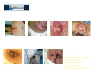 Grupo de pele
                Protocolo de tratamento de úlcera de Pressão
Estágio I ou Grau I      Estágio II ou Grau II      Estágio III ou Grau III        Estágio IV ou Grau IV




AGE CREME                 HIDROGEL                  HIDROGEL + FILME TRANS.        ALGINATO DE CÁLCIO + PHMB
AGE ÓLEO                  HIDRPOLÍMERO              ALGINATO + PHMB                HIDROPOLÍMERO P/ CAVIDADE
                          MALHA C/PETROLATUM        HIDROPOLÍMERO P/ CAVIDADE
                          HIDROCOLÓIDE PLACA        VAC
                                                                              OBSERVAÇÃO:
Escara + Infecção      Escara sem Infecção 1 Escara sem Infecção 2            Além dos curativos especiais é necessário
                                                                              outras condutas




                                                                              MUDANÇA DE DECÚBITO RIGOROSA
                                                                              SURORTE EMOCIONAL
                                                                              SUPORTE NUTRICIONAL

  ALGINATO + PHMB        ALGINATO + PHMB         ALGINATO + PHMB              CONTROLE TÊRMICO
  CARVÃO ATIVADO         ALGINATO + SF 0,9%      PLACA DE HIDROGEL            CONTROLE HIDROELETROLÍTICO
     17/04/12
  CURATIVO COM PRATA
  ALGINATO + SF 0,9%
                         COLAGENASE
                         PAPAÍNA 10 E 6%
                                        Patricia Coelho
                                                 ALGINATO + SF 0,9%
                                                 COLAGENASE
                                                                              ATUALIZADA CONFORME GUIDELINES DA EPUAP/NPUAP
 