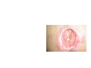 3 dias depois, sem
sinais flogísticos, abriu
cavidade, porém com
tecido de epitelização




                   Patricia Coelho   1717
 