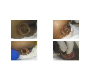 Técnica de square com injeção de
soro fisiológico




            Enfermeira Patrícia
            Coelho
 