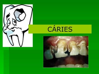 CÁRIES 
