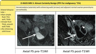 O Rads Example Mri orads mri radiology staging ppt for pgs.pptx