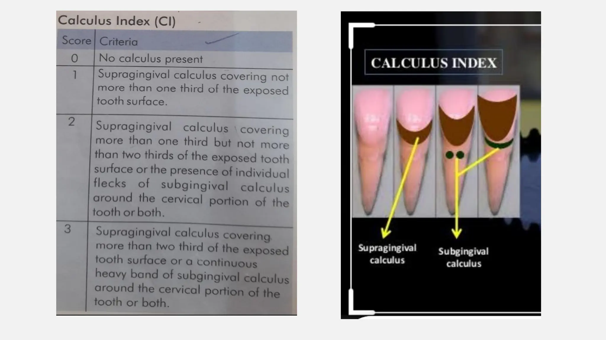 Oral Hygine Index and oral hygiene index simplified PPT