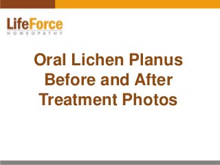 Oral Lichen Planus
Before and After
Treatment Photos
 