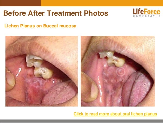 Natural Remedies For Lichen Planus Of The Mouth Natural Remedies For Lichen Planus Of The Mouth