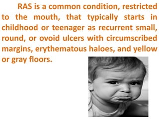RAS is a common condition, restricted
to the mouth, that typically starts in
childhood or teenager as recurrent small,
round, or ovoid ulcers with circumscribed
margins, erythematous haloes, and yellow
or gray floors.
 