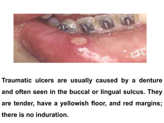 Traumatic ulcers are usually caused by a denture
and often seen in the buccal or lingual sulcus. They
are tender, have a yellowish floor, and red margins;
there is no induration.
 