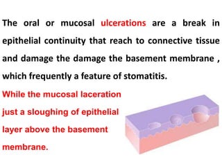 The oral or mucosal ulcerations are a break in
epithelial continuity that reach to connective tissue
and damage the damage the basement membrane ,
which frequently a feature of stomatitis.
While the mucosal laceration
just a sloughing of epithelial
layer above the basement
membrane.
 