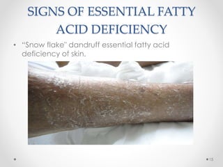 Oral and Cutaneous Signs of Vitamin, Zinc and Fatty Acid Deficiency | PPTX