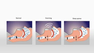 Snoring Reference Prosthetic Management of sleep apnea and snoring | PPTX