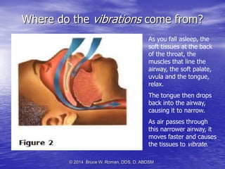 Oral Appliances for Snoring and Obstructive Sleep Apnea | PDF