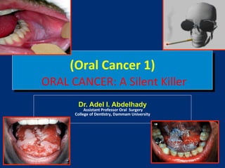 (Oral!Cancer!1)!

!ORAL!CANCER:!A!Silent!Killer!
Dr. Adel I. Abdelhady

!Assistant!Professor!Oral!!Surgery!
College!of!Den5stry,!Dammam!University!
!

 