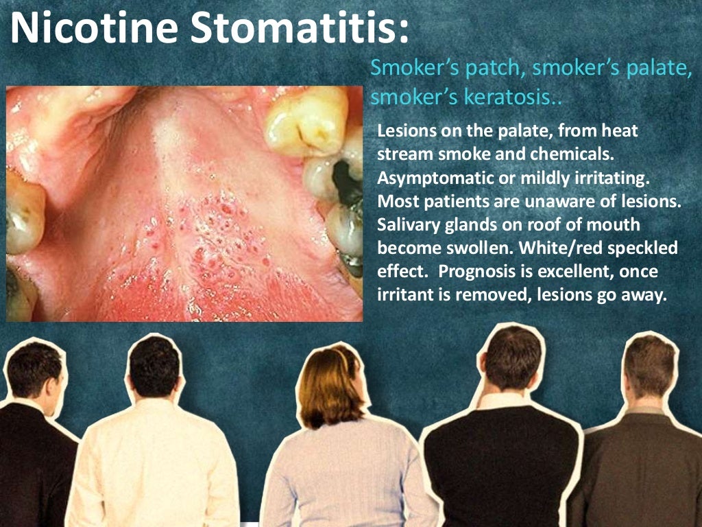 The Dangers of Tobacco Use in Oral and Systemic Health