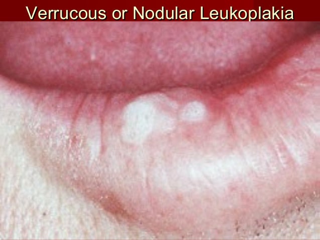 oral cancer
