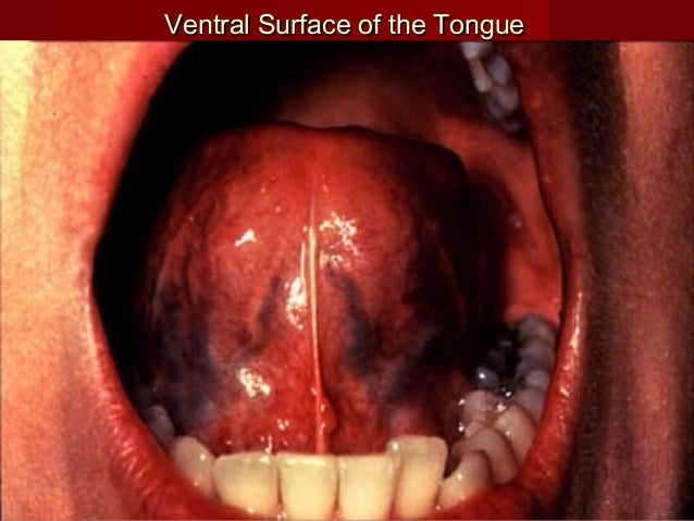 Oral Cancer
