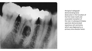 Periapical radiograph
demonstrating bone
destruction in the furcation of
the first molar tooth and
associated resorption of
the root. A subsequent biopsy
specimen demonstrated
squamous cell carcinoma,
which was diagnosed as a
primary intra-alveolar lesion.
 