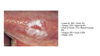 • Lower lip. 38% • Tonsil. 5%~
• Tongue. 22% • Upper lip 4%
• Floor of mouth, 17% • Buccal mucosa.
2%
• Gingiva, 6% • Uvula. 0.5%
• Palate. 5.5%
 