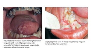 Exophytic growth seen in malignancy showing irregular
margins and surface ulceration
Indurated and ulcerated lesion of the right anterior
tongue in a 15-year-old girl, persisting after
removal of orthodontic appliances, proven to be
squamous cell carcinoma on biopsy
 