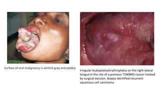 Surface of oral malignancy is whitish gray and pebbly
Irregular leukoplakia/erythroplakia on the right lateral
tongue in the site of a previous T1N0MO cancer treated
by surgical excision. Biopsy identified recurrent
squamous cell carcinoma
 