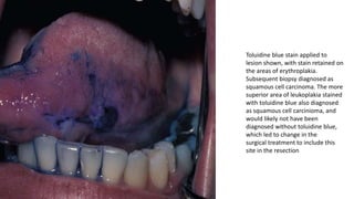Toluidine blue stain applied to
lesion shown, with stain retained on
the areas of erythroplakia.
Subsequent biopsy diagnosed as
squamous cell carcinoma. The more
superior area of leukoplakia stained
with toluidine blue also diagnosed
as squamous cell carcinioma, and
would likely not have been
diagnosed without toluidine blue,
which led to change in the
surgical treatment to include this
site in the resection
 