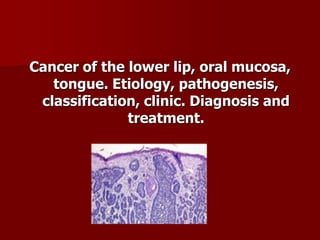 Cancer of the lower lip, oral mucosa,
tongue. Etiology, pathogenesis,
classification, clinic. Diagnosis and
treatment.
 