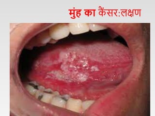 Oral cancer hindi.pptx