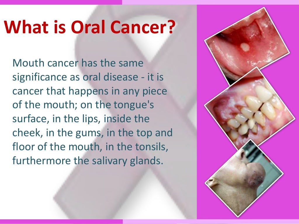 Oral Cancer Treatment in Delhi