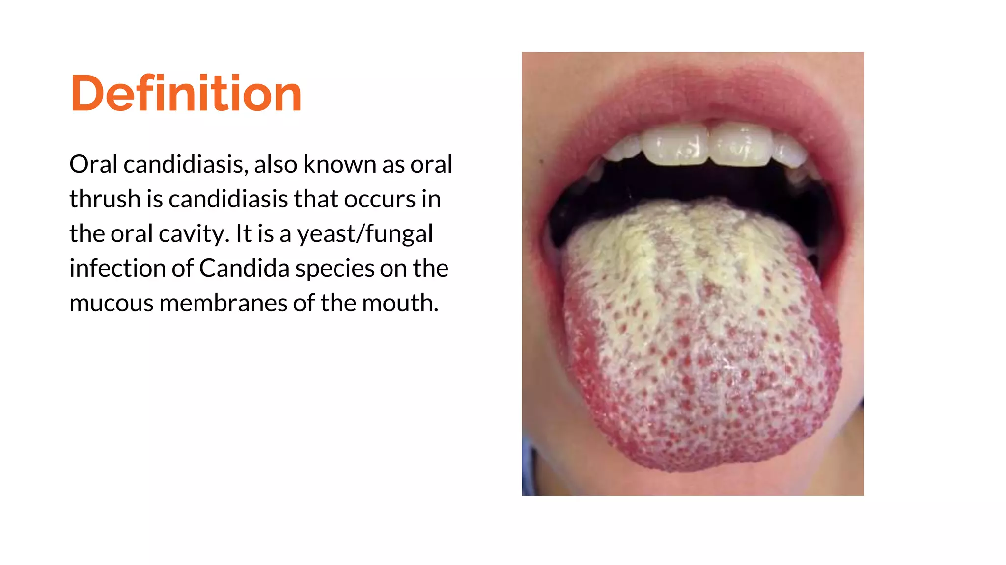Oral Candidiasis pptx