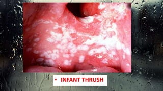 • INFANT THRUSH
11
 