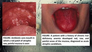 FIGURE: A patient with a history of chronic iron
deficiency anemia developed red, raw, and
painful areas of the mucosa, diagnosed as acute
atrophic candidiasis.
FIGURE: Antibiotic sore mouth in
which a red patch of atrophic
raw, painful mucosa is seen
23
 