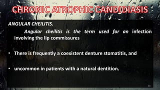 ANGULAR CHEILITIS.
Angular cheilitis is the term used for an infection
involving the lip commissures
• There is frequently a coexistent denture stomatitis, and
• uncommon in patients with a natural dentition.
30
 