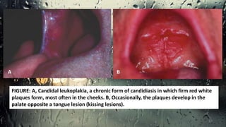 A B
FIGURE: A, Candidal leukoplakia, a chronic form of candidiasis in which firm red white
plaques form, most often in the cheeks. B, Occasionally, the plaques develop in the
palate opposite a tongue lesion (kissing lesions).
37
 
