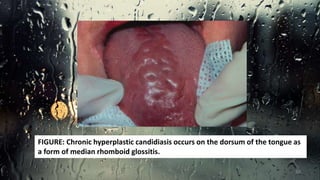 FIGURE: Chronic hyperplastic candidiasis occurs on the dorsum of the tongue as
a form of median rhomboid glossitis.
38
 